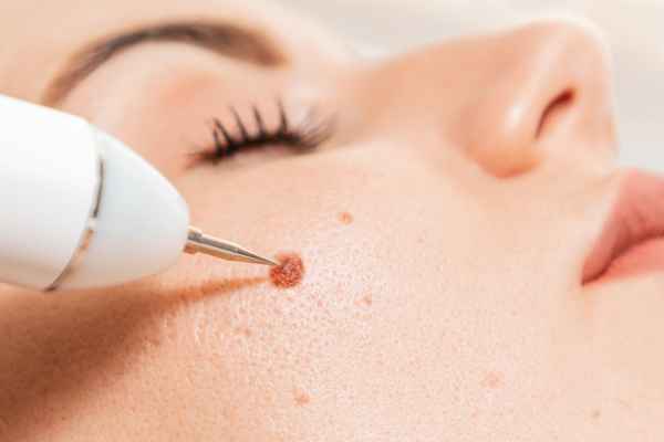 CryoPen: 5 Skin Concerns It May Be Used to Treat 3 What actually happens during a CryoPen treatment West Sussex?