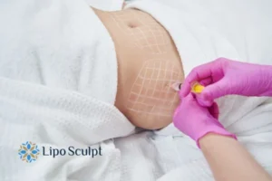 Are The Results From Aqualyx Permanent? 1 Do you want to know how long Aqualyx West Sussex results last?