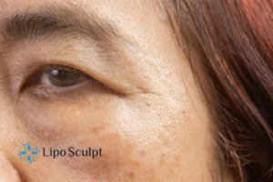 Cryopen: The Revolutionary Treatment for Age Spots Unveiled 2 Are age spots West Sussex giving you low self esteem? Contact us today!