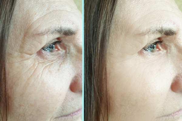Why Do People Choose HIFU for a Non-Surgical Facelift? 4 How long can HIFU results last West Sussex?