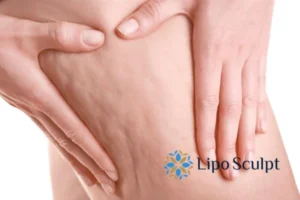 CoolSculpting for Legs: The Innovative Approach to Redefining Your Legs 5 Start your journey today book your coolsculpting treatment West Sussex online today!