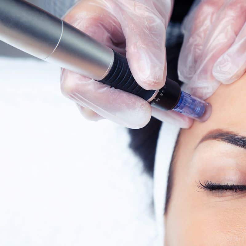 Morpheus8 treatment West Sussex from Lipo Sculpt - Book in today!