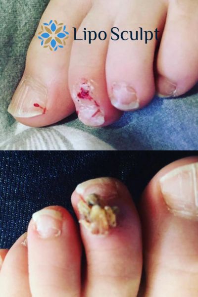 Wart removal customer results from Lipo Sculpt West Sussex