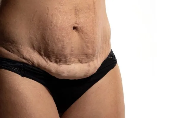 Lost the Weight but Not the Loose Skin? 1 image of womans stomach after weight loss showing loose skin West Sussex